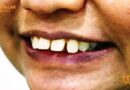 सिद्धार्थ नगर – बच्चों में बाहर की तरफ निकलते दांत: कारण, निवारण और उपचार विधियाँ चर्चा में आज डेंटिस्ट डॉ अल्शिमा हफीज