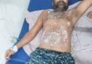 आकाशीय बिजली की चपेट में आने से युवक गंभीर रूप से झुलसा, जेब में रखा मोबाइल दो टुकड़ों में टूटा