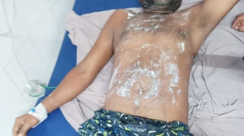 आकाशीय बिजली की चपेट में आने से युवक गंभीर रूप से झुलसा, जेब में रखा मोबाइल दो टुकड़ों में टूटा आकाशीय बिजली की चपेट में आने से युवक गंभीर रूप से झुलसा, जेब में रखा मोबाइल दो टुकड़ों में टूटा